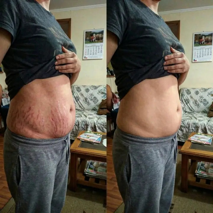 Voor y después de estrías en abdomen con Cryo Thermo