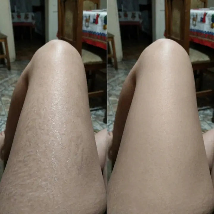 Voor y después de estrías en muslos con Cryo Thermo