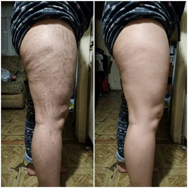 Voor y después de estrías en pierna con Cryo Thermo